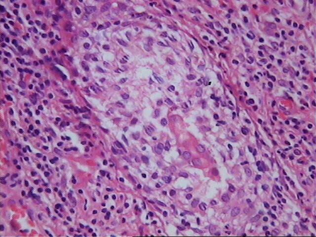 Fig.6 Presencia de granuloma en MF - <div style=